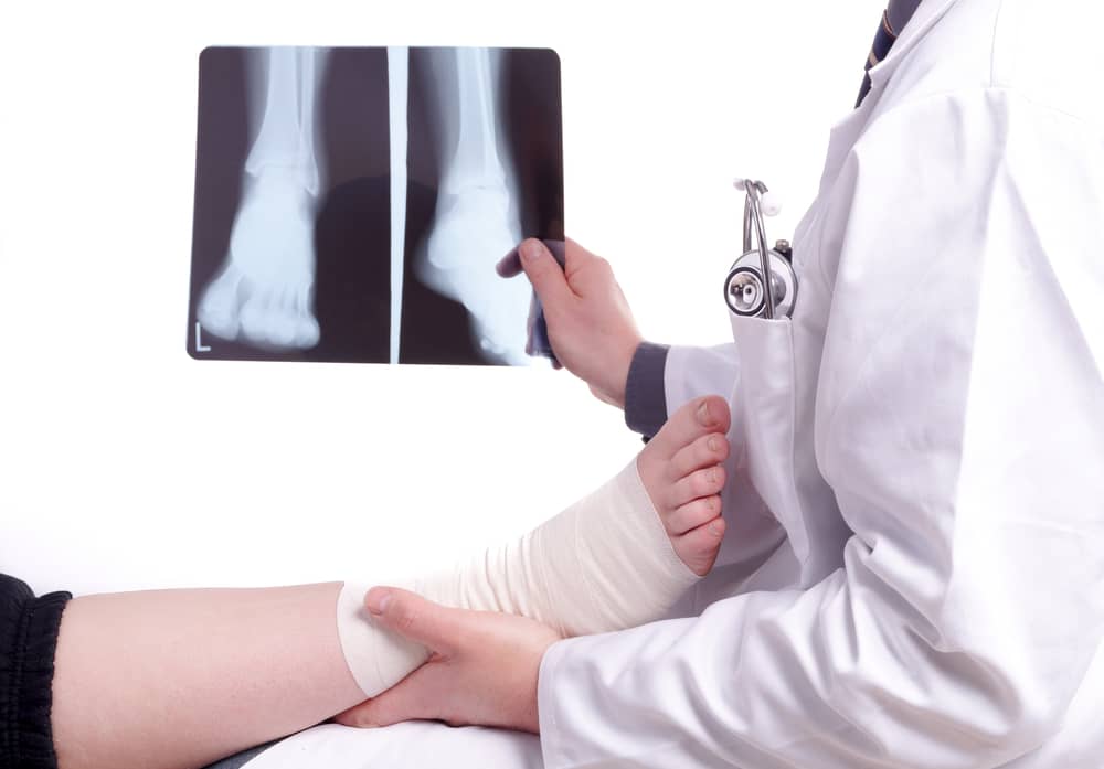 broken-ankle-treatment-sunnyvale-orthopedic-center