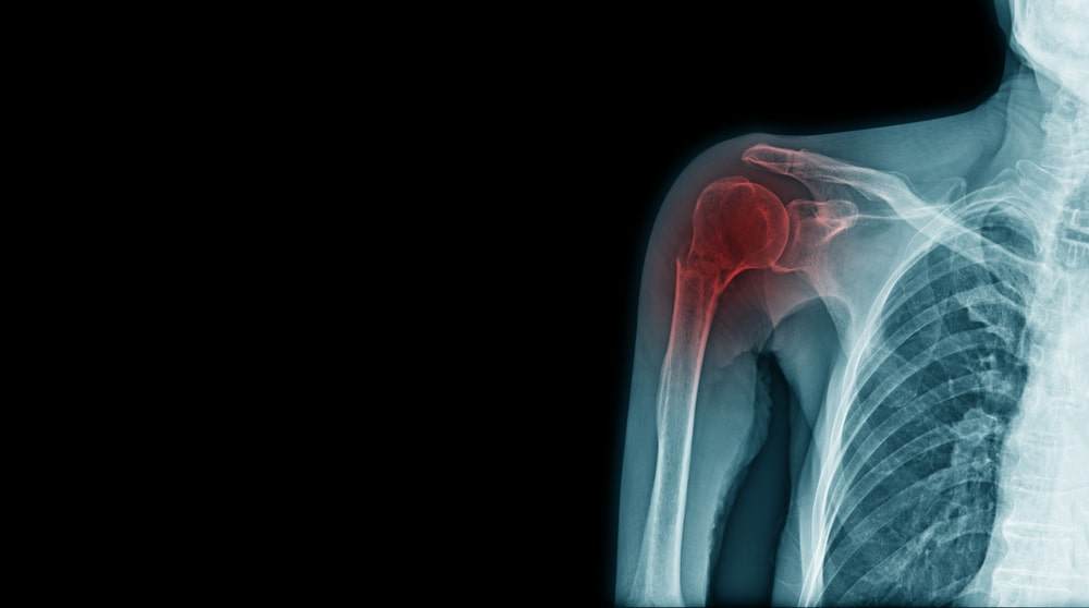 Torn rotator cuff can be fixed.