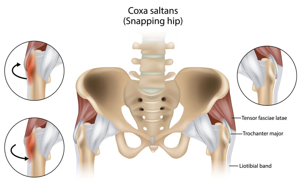 Finding an effective treatment for Snapping Hip Syndrome – Caring