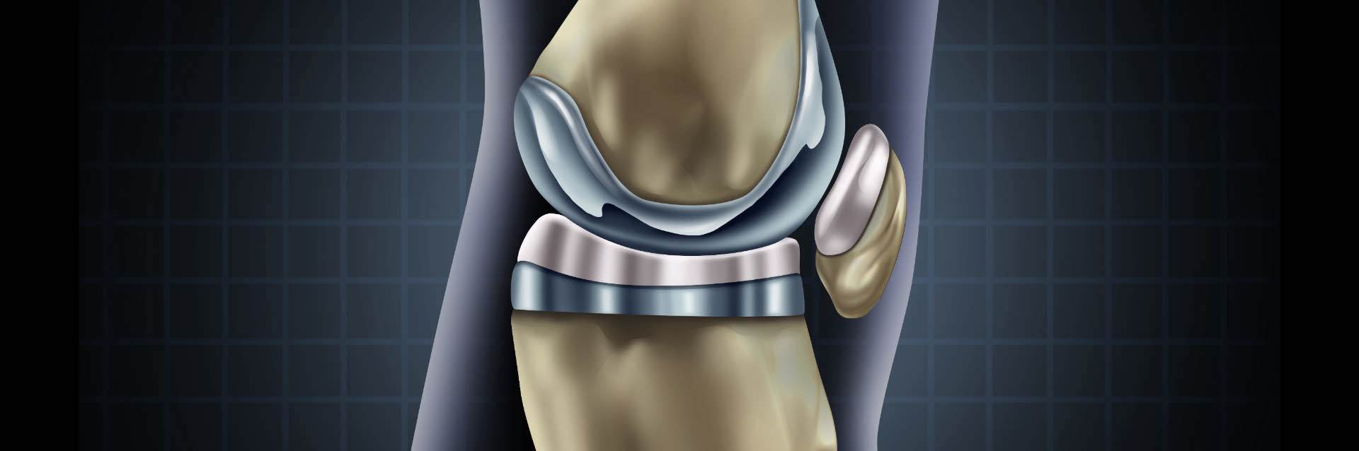 Medical illustration of a knee joint showing cartilage and bone structure